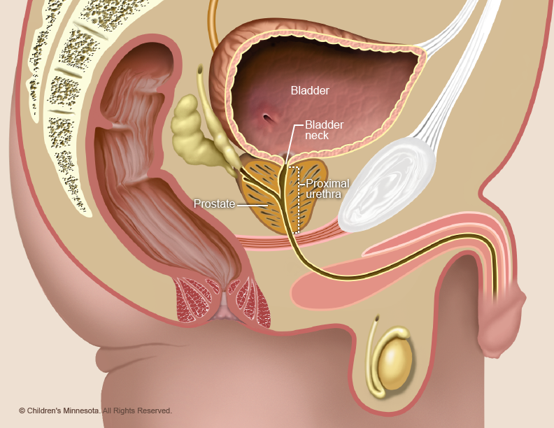 Lower Urinary Tract Obstruction LUTO Children s Minnesota