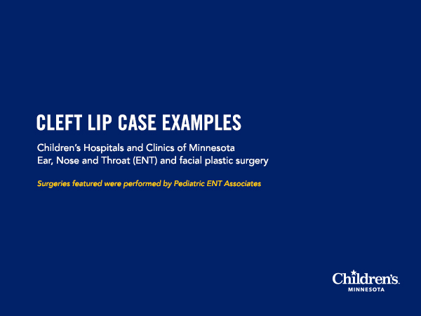 Cleft lip case examples