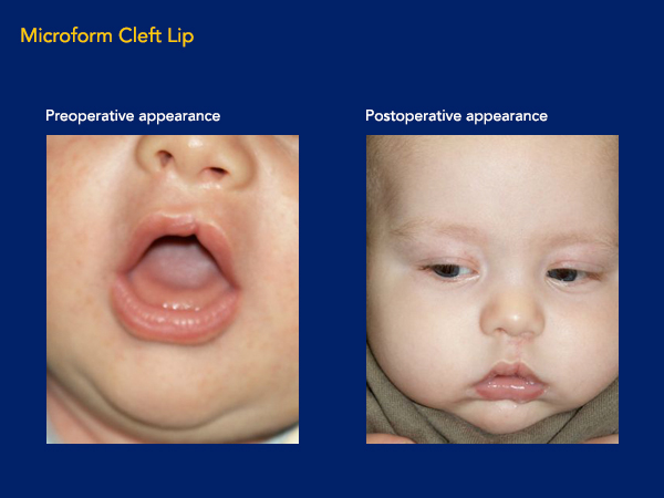 Microform cleft lip