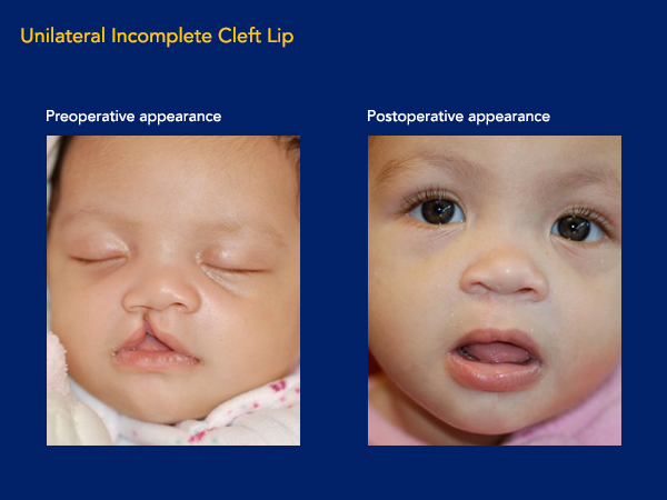 Unilateral incomplete cleft lip