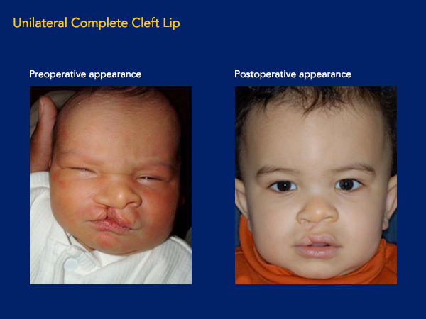 Unilateral complete cleft lip