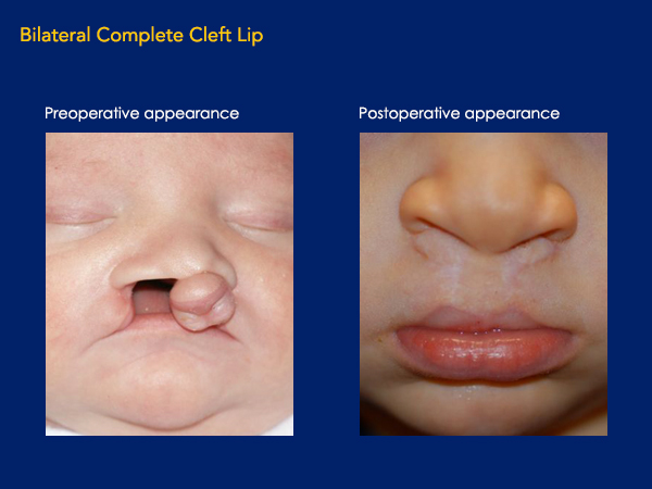 Bilateral complete cleft lip