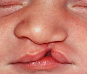 Small incomplete cleft lip