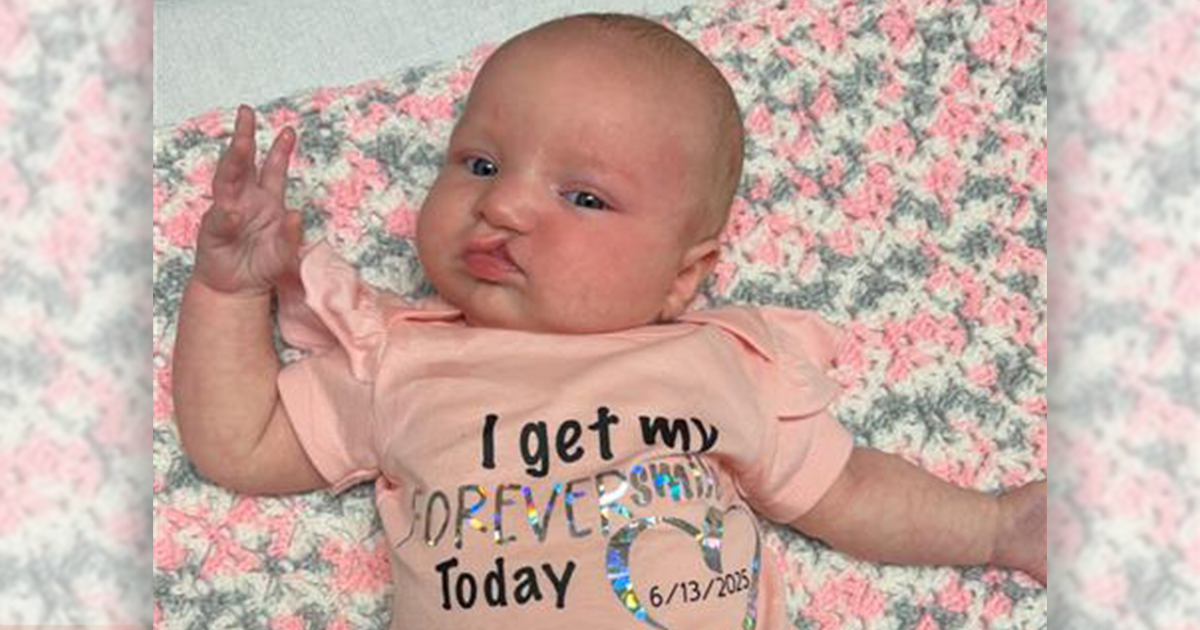 New cleft lip treatment helps Luna to her ‘forever smile’