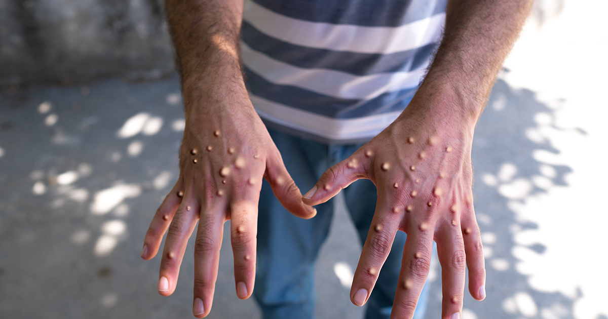 Got rashes? How do you know it's Monkeypox, not something else?