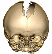 An image of a skull displaying Craniosynostosis Bicoronal