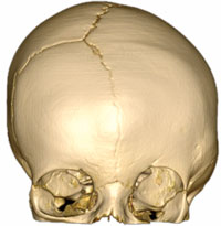 An image of craniosynostosis coronal on the left side of the skull
