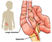 perforated appendix