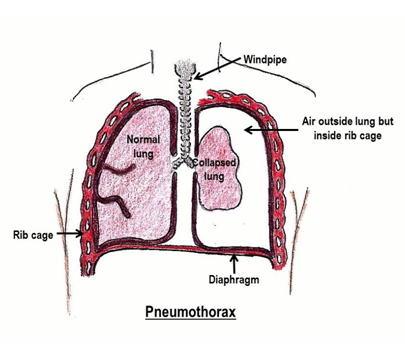 hemopneumothorax diagram
